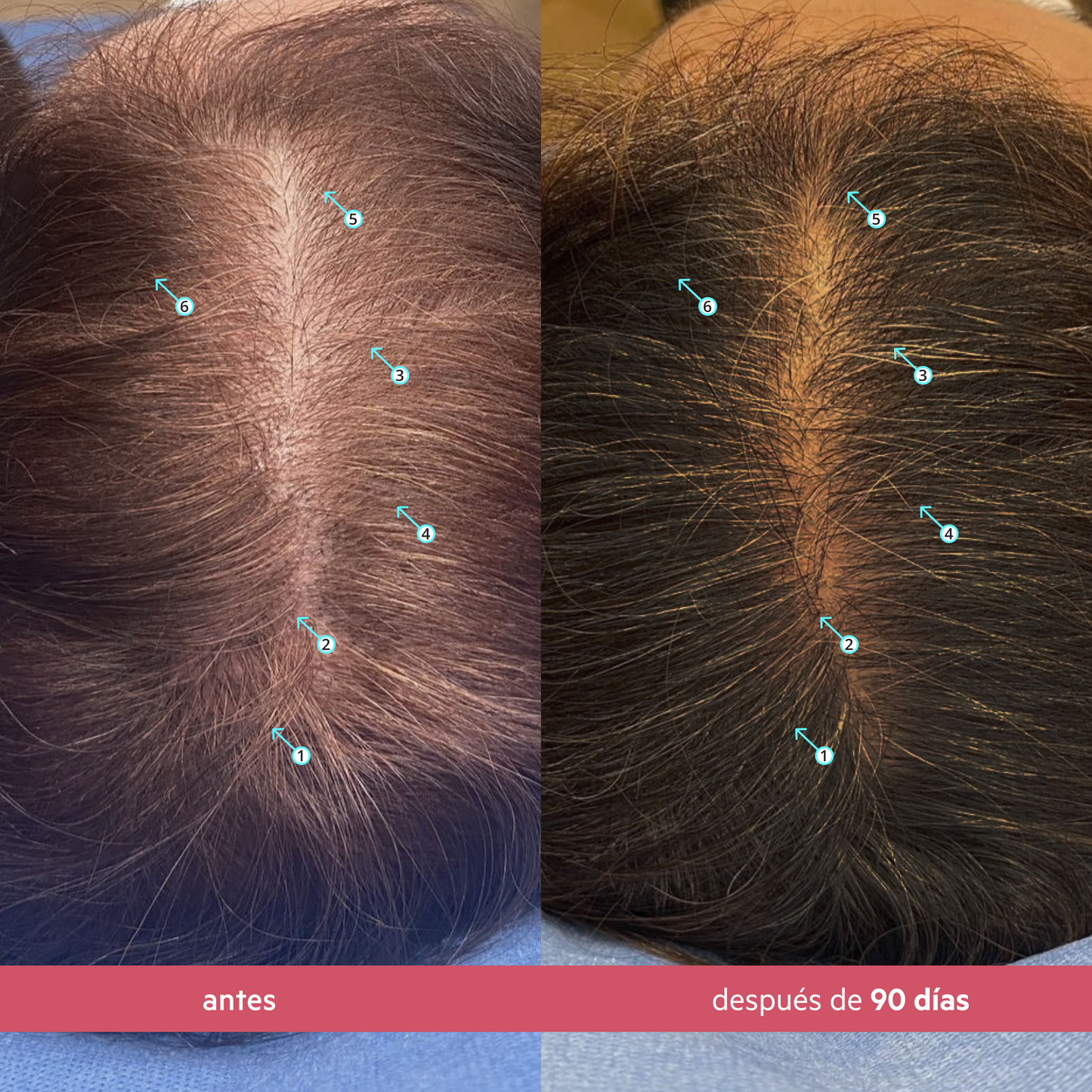 Spectral.Women's® | TRATAMIENTO REVITALIZANTE CON NANOXIDIL 5%