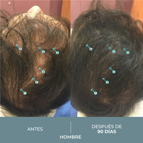 Revita.SOD® 90 Comprimidos | Primer Nutraceútico para la Pérdida de Cabello Relacionada con el Estrés